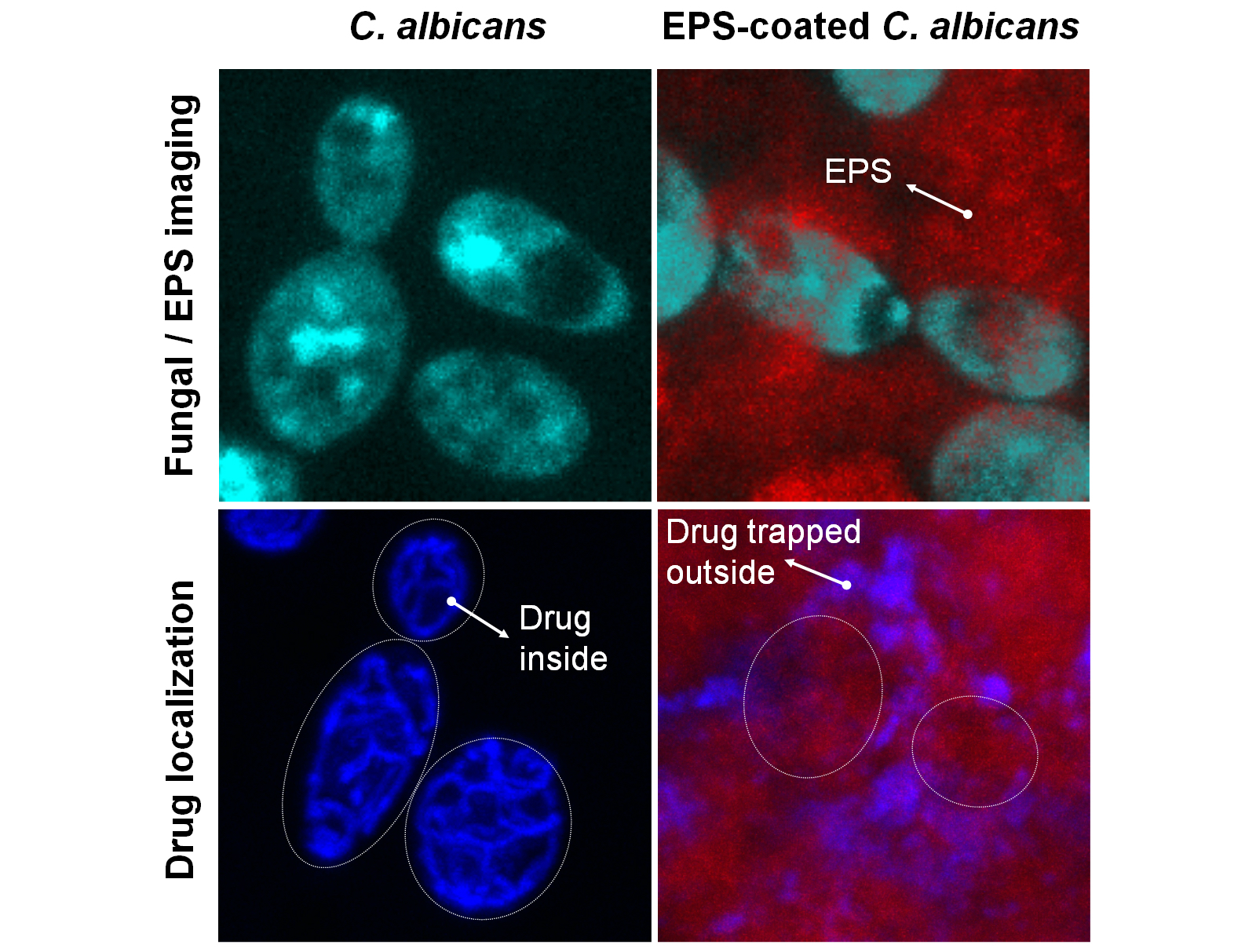 Bacteria boost antifungal drug resistance in severe childhood tooth